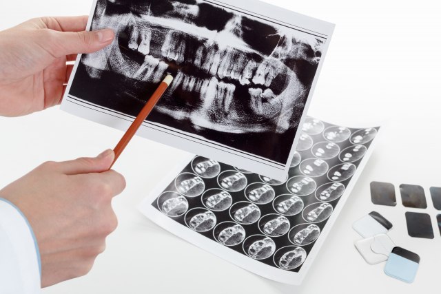 Važan korak u stomatološkom lečenju – snimanje zuba